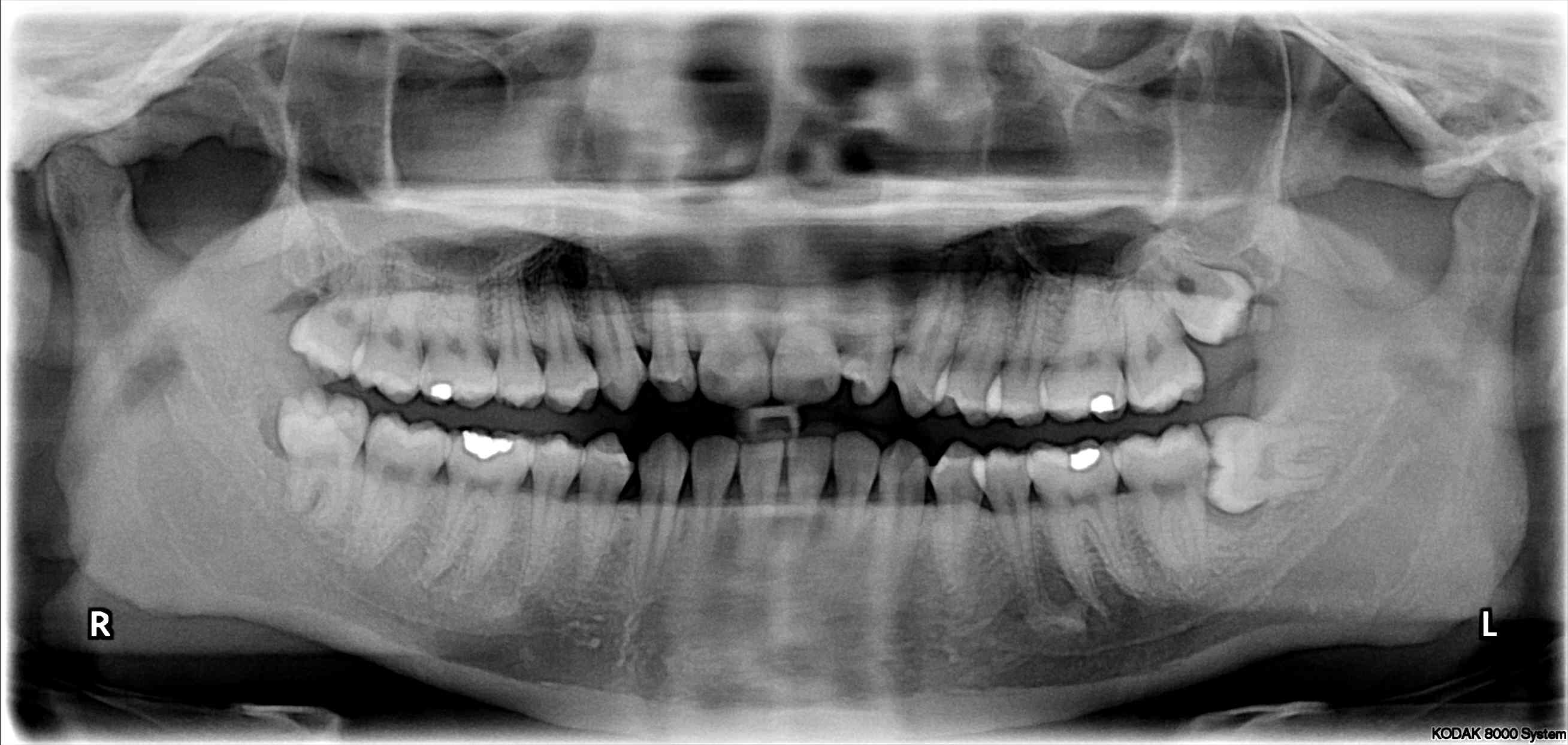 Wisdom Teeth What You Should Know About Extraction Inner Banks Dental