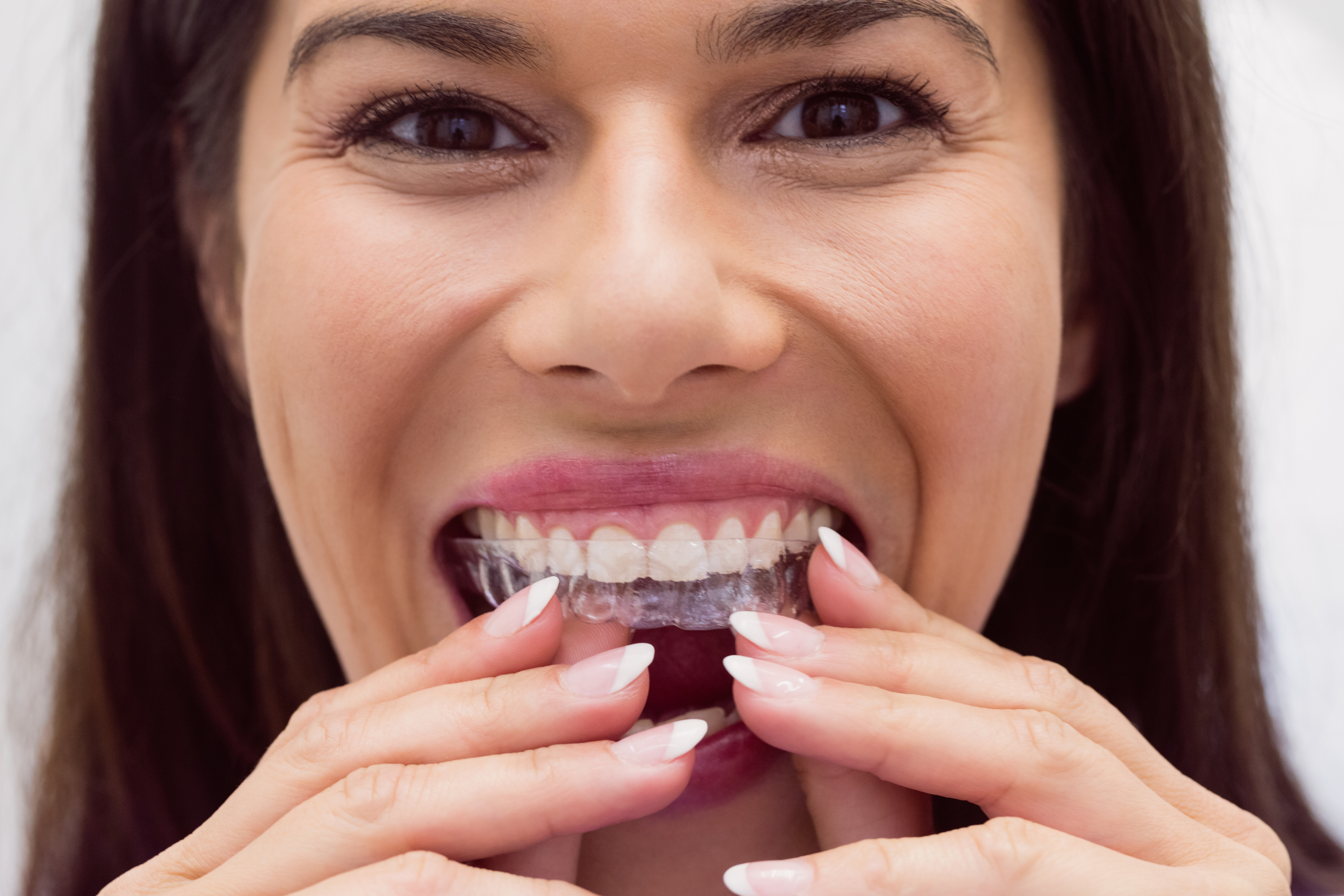 Braces For Adults: What to Know About Clear Aligners - Inner Banks Dental